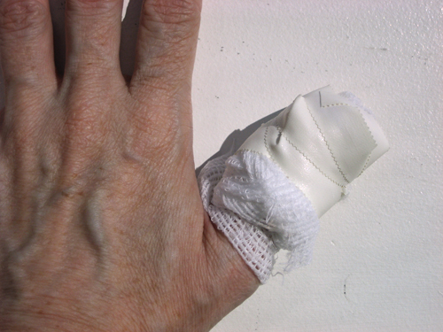My hugely bandaged thumb